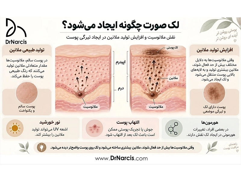 لک صورت چیست و چگونه ایجاد می‌شود